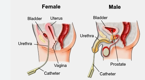 https://maykres.my.id/kateter-uretra-kegunaan-jenis-dan-efek-samping/:Uses, Types, and Side Effects